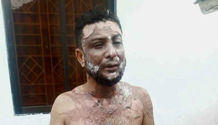 জামালপুরে ডাকাতি: বাধা দেওয়ায় স্বামী-স্ত্রীকে এসিডে ঝলসে দিল দুর্বৃত্তরা